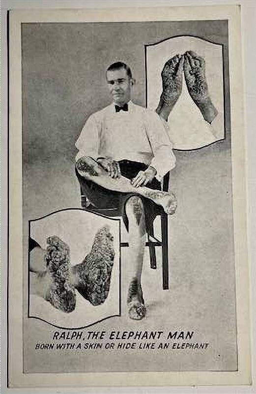 RALPH – THE ELEPHANT MAN ~ SKIN LIKE AN ELEPHANT ~ c. – 1920